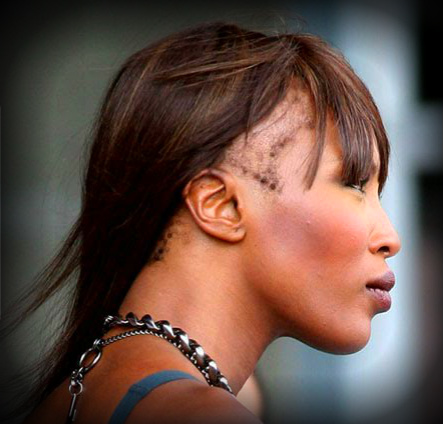 How to Reverse Traction Alopecia | LIVESTRONG.COM